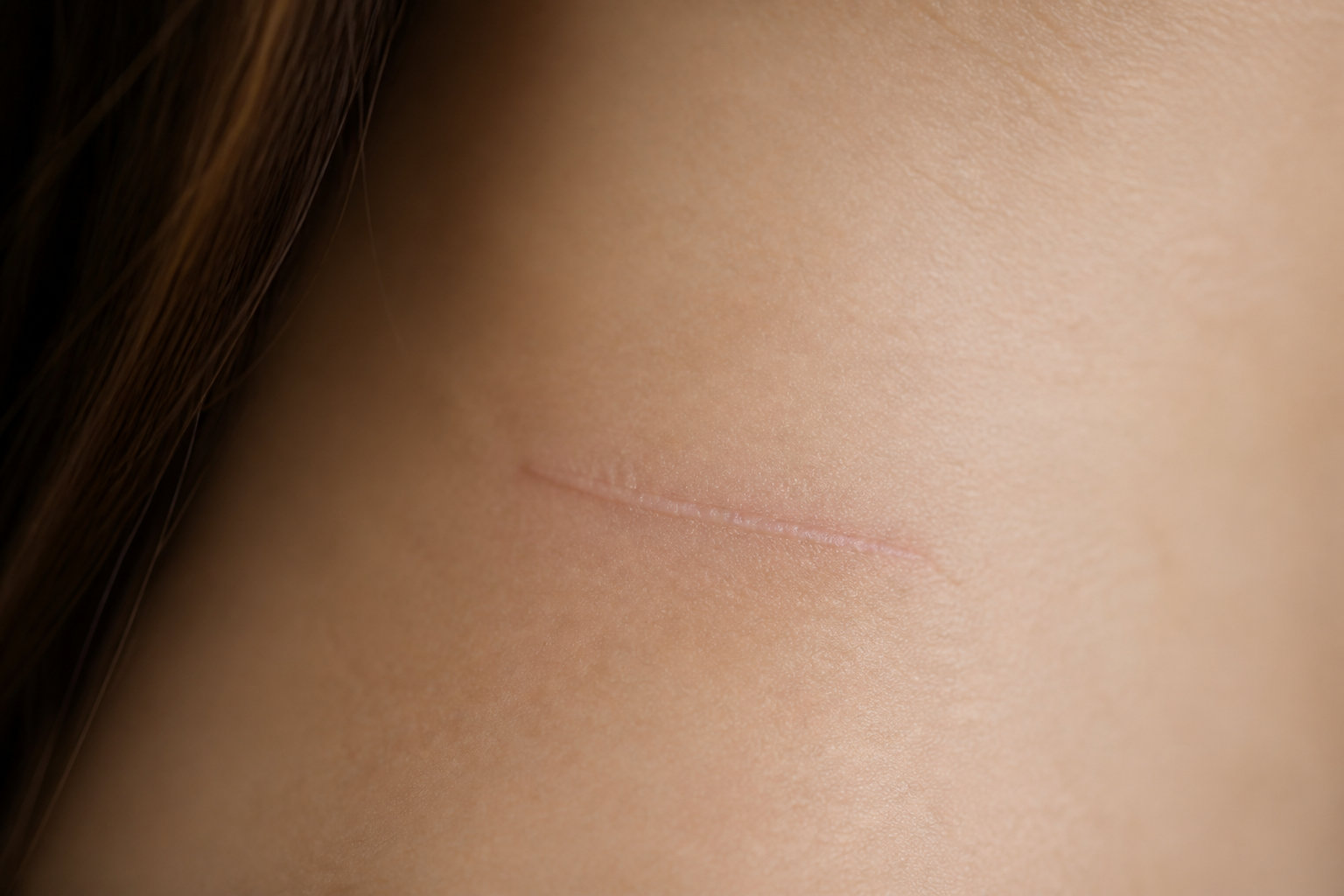 Cicatrices et incisions selon votre morphologie