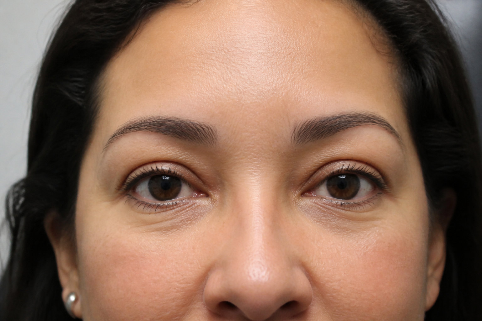 Comprendre la blépharoplastie et la chirurgie des paupières
